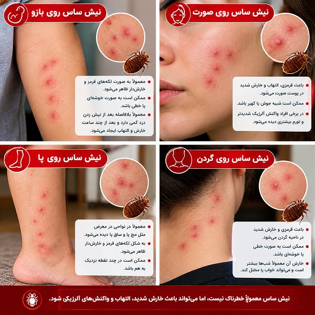 انواع نیش ساس در اعضای بدن